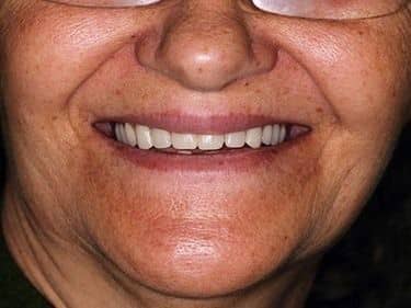 Complete and partial Dentures