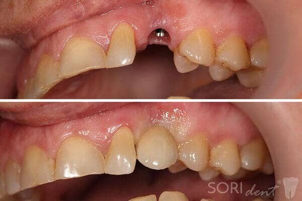 Implant dentar - Înainte și după tratamentul stomatologic
