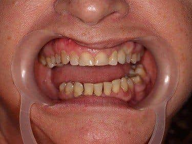 Implant dentar cu coroană metalo-ceramică