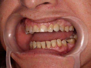 Implant dentar cu coroană metalo-ceramică