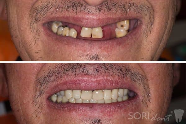 Proteze dentare - Înainte și după tratamentul stomatologic