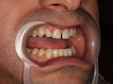 Zâmbet refăcut - Coroană dentară din Zirconiu