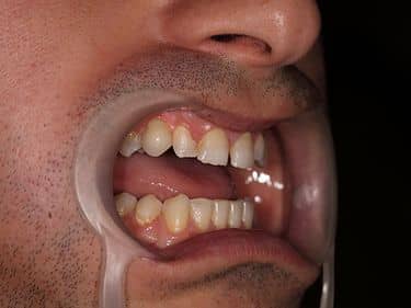 Zirconia dental crown over dental implant