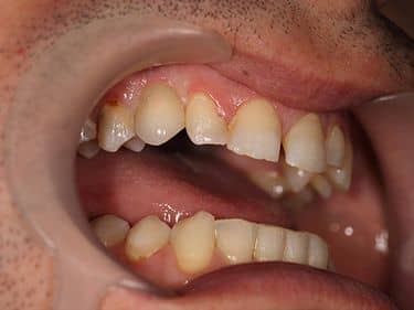 Coroană dentară din Zirconiu pe Implant Dentar