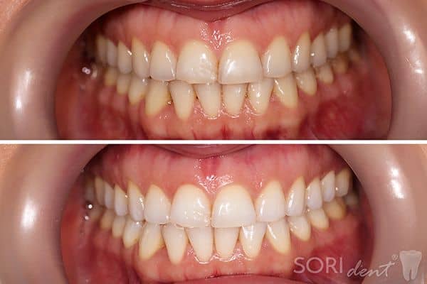 Albire dentară cu lampă UV tip Zoom / Beyond / Advanced Whitening - Înainte și după tratamentul stomatologic