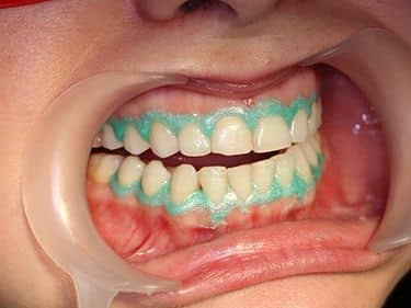 DURING TREATMENT - Applying the gingival barrier