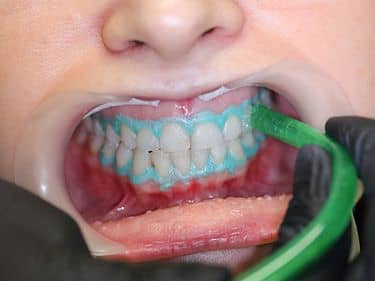DURING TREATMENT - Removing the whitening gel and the gingival barrier