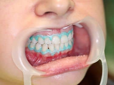 DURING TREATMENT - Removing the whitening gel and the gingival barrier