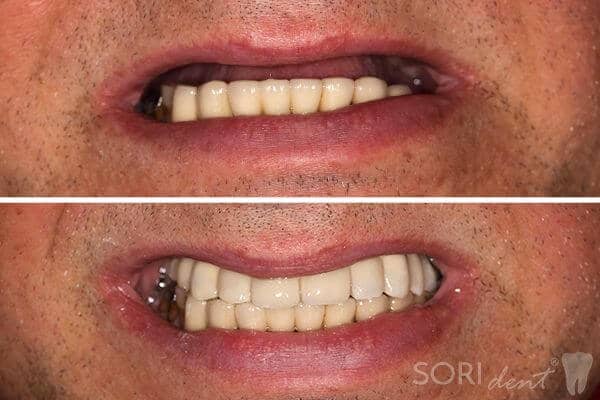 Implanturi Dentare - All-on-six - Înainte și după tratamentul stomatologic