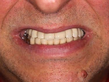 Restored smile - Porcelain dental bridge over implants - All-on-six
