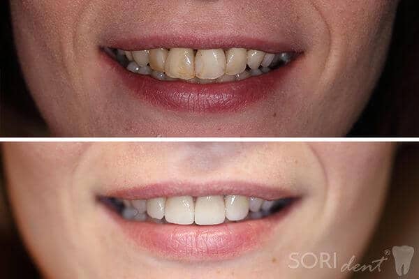 Fațete Dentare și Coroane Integral Ceramice e-max - Înainte și după tratamentul stomatologic