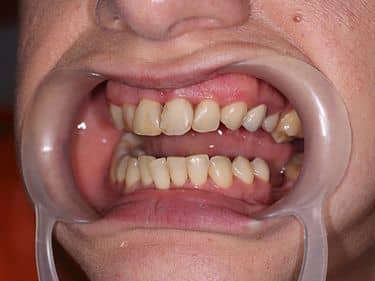 Dinți frontali închiși la culoare