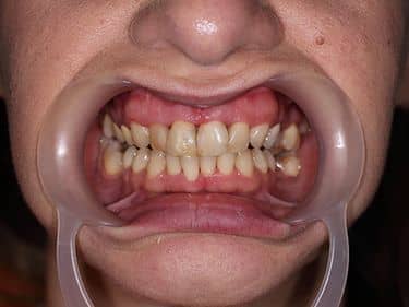 Dinți frontali închiși la culoare