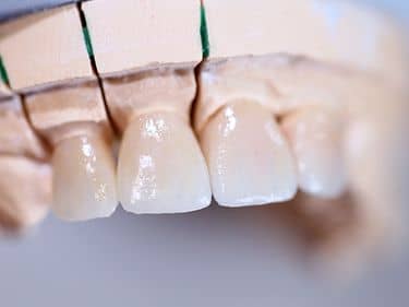 Fațete dentare și coroane integral ceramice e-max