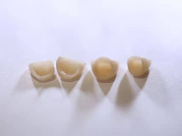 Fațete dentare și coroane integral ceramice e-max