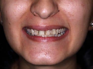 Multiple dental cavities