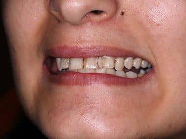 Multiple carii dentare