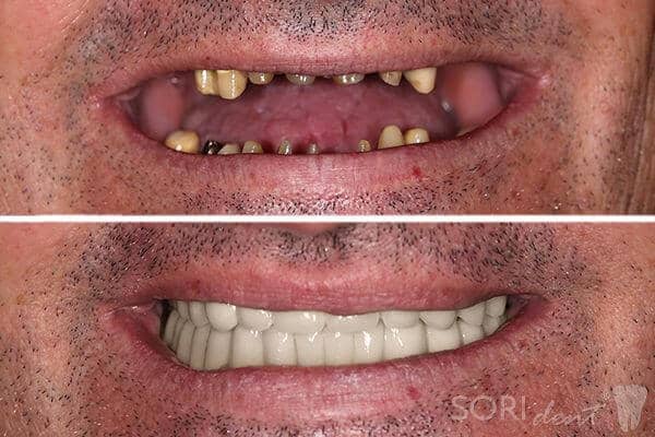 Punți Dentare Fixe Metalo-Ceramice - Înainte și după tratamentul stomatologic