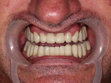 Full Fused-to-metal Porcelain Dental Bridges over teeth and dental implants