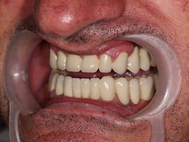 Punți Dentare Metalo-ceramice Fixe cu protezare mixtă