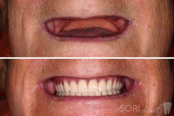 Full Dentures - Before and after dental treatment
