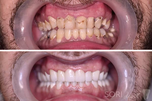 Coroane Dentare din Ceramică pe oxid de Zirconiu - Înainte și după tratamentul stomatologic