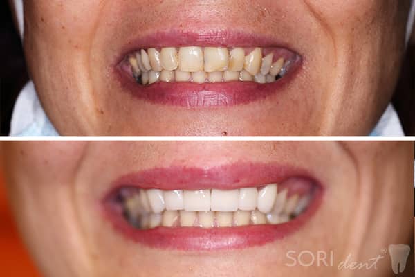Fațete Dentare ceramice e-Max - Înainte și după tratamentul stomatologic