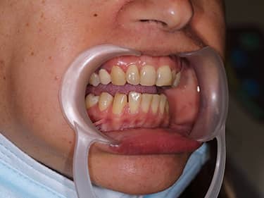 Very discoloured frontal teeth