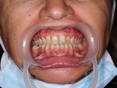 Very discoloured frontal teeth