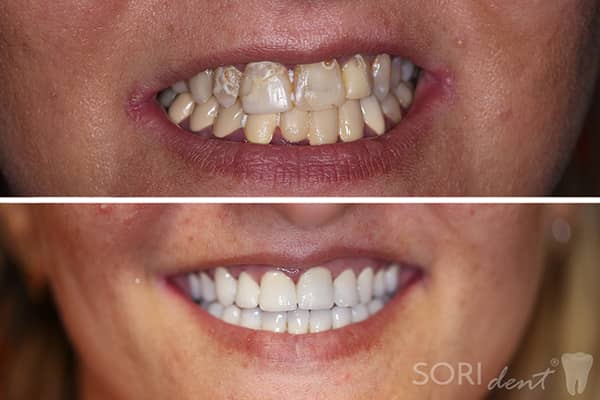 Porcelain Dental Bridges and Crowns - Before and After Dental Treatment