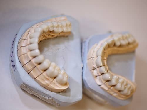 Dental porcelain bridges and crowns