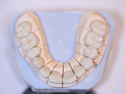 Dental porcelain bridges and crowns