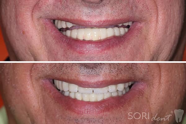 Porcelain Bridges over Dental Implants - Before and After Dental Treatment