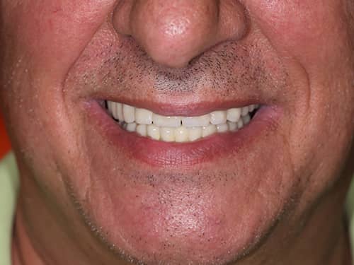 Lucrări din porțelan pe Implanturi Dentare