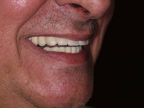 Porcelain Dental Bridges over Implants