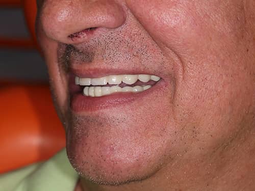 Porcelain Dental Bridges over Implants
