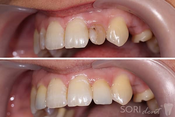 Coroane Dentare ceramice e-Max - Înainte și după tratamentul stomatologic