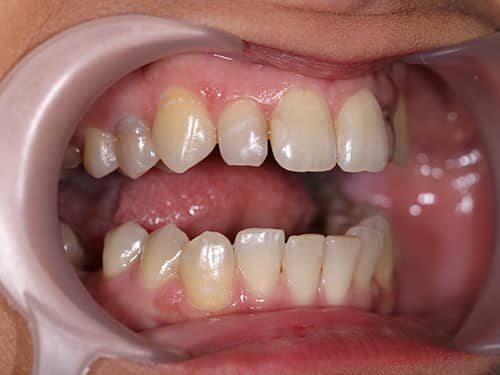 Discoloured Lateral Incisors