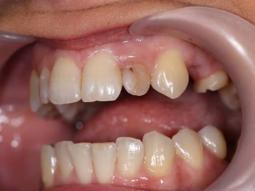 Discoloured Lateral Incisors