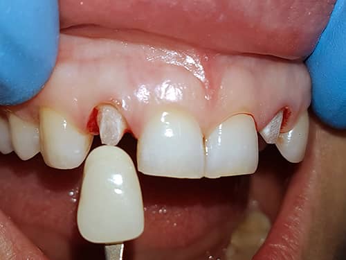 Prepared lateral incisors