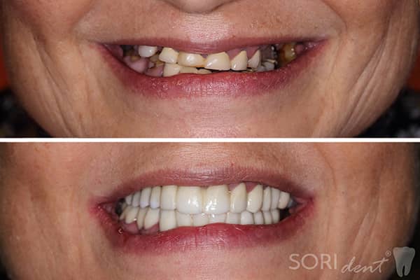 Full-Zirconia Dental Bridges over Implants and natural teeth - Before and after dental treatment