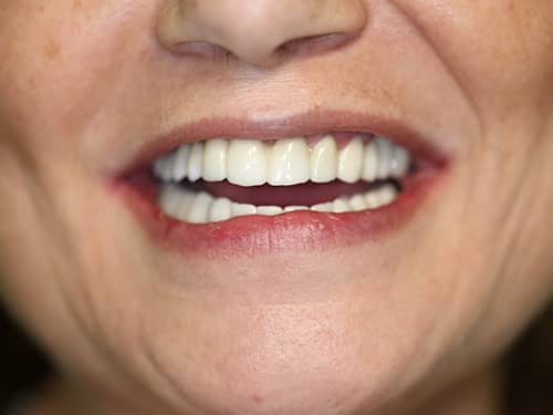 Full Zirconia dental bridges over Dental Implants