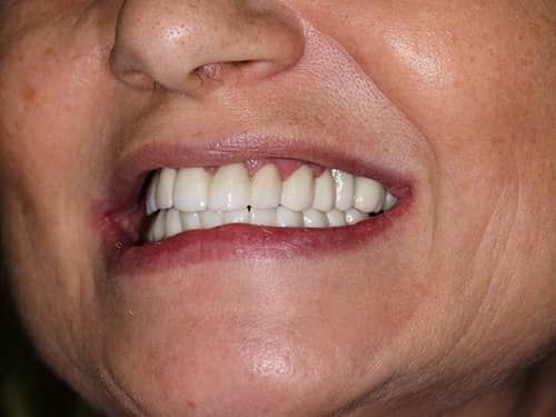 Lucrări din Full-Zirconia (oxid de Zirconiu) pe Implanturi Dentare