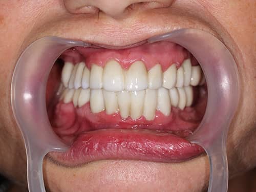 Full Zirconia dental bridges over Dental Implants