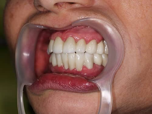 Lucrări din Full-Zirconia (oxid de Zirconiu) pe Implanturi Dentare