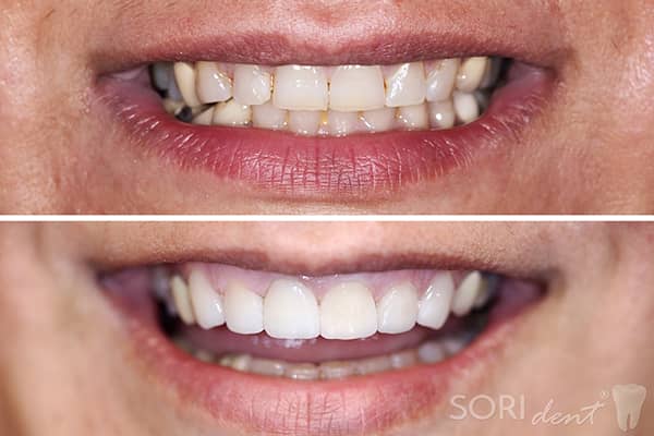 e-Max Dental Ceramic Veneers - Before and after treatment