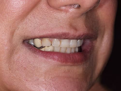 Discoloured front teeth