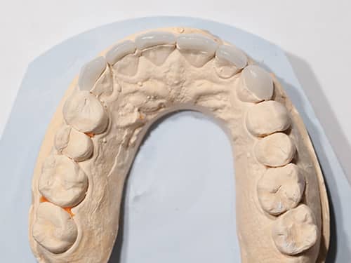 e-Max Ceramic Dental Veneers e-Max
