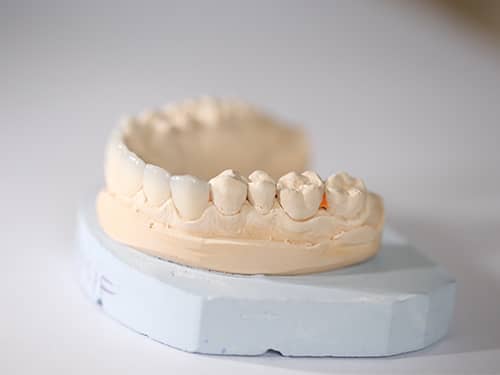 e-Max Ceramic Dental Veneers e-Max