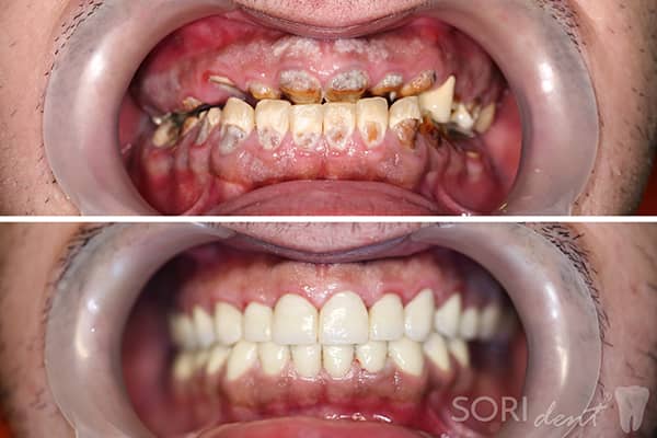 Amelogenesis Imperfecta - Coroane Dentare din Ceramică pe oxid de Zirconiu - Înainte și după tratamentul stomatologic